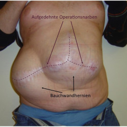Mäßige Bauchwandhernie