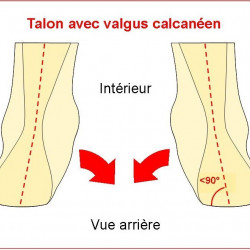 Pathologies Calcaneal Valgus