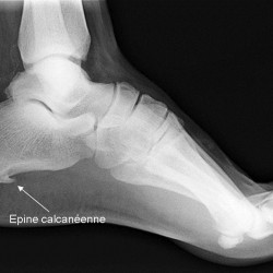 Epine calcanéenne ou douleurs au talon soulager par des semelles
