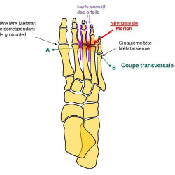 Morton’s neuroma 