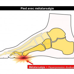 Douleurs des orteils ou métatarsalgies médianes