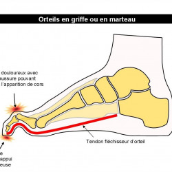 Claw or hammer toes