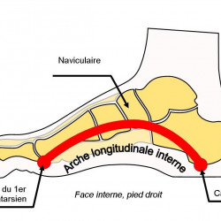 Sagging arch of the foot 