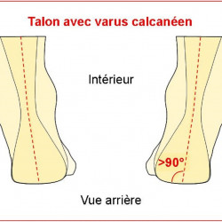Varus calcanéen ou pied supinateur
