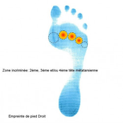Fußsohlenabdruck mit Schmerzen 2.,3. bzw. 4. Mittelfußknochenkopfes