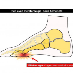 Metatarsalgia of the 5th toe