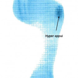 Hyper pressure under the 5th metatarsal head