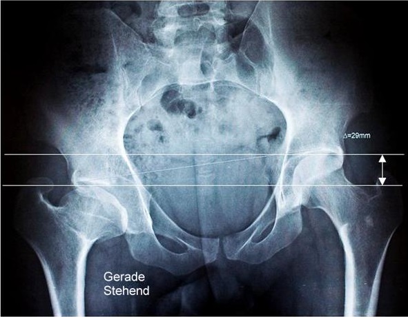 Röntgenaufnahme des Beckens von vorne