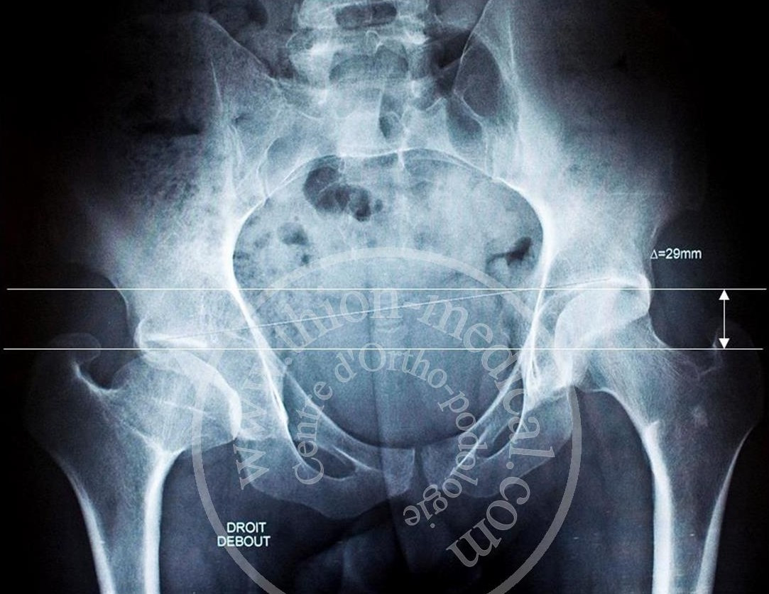 La bascule du bassin 