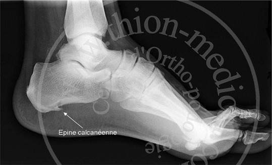 Epine calcanéenne